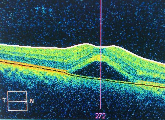 Retinopathy of Prematurity