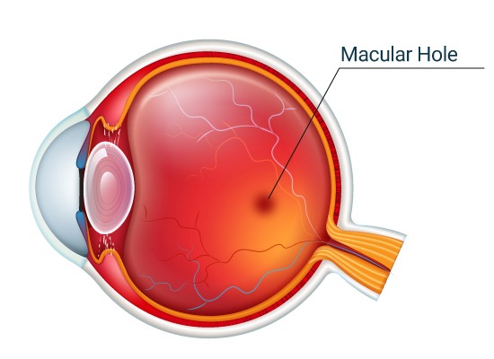 Macular Hole