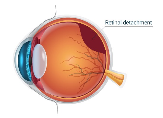 Retinal Detachment