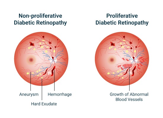 Diabetic Retinopathy