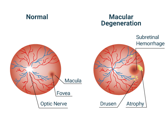 Retinal Detachment