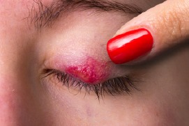 Chalazion