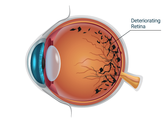 Diabetic Retinopathy